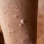 Fedefarma pide unir esfuerzos para vencer barreras de diagnóstico, acceso a terapias y calidad de vida de pacientes con enfermedades raras