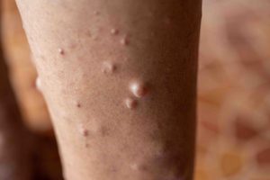 Fedefarma pide unir esfuerzos para vencer barreras de diagnóstico, acceso a terapias y calidad de vida de pacientes con enfermedades raras